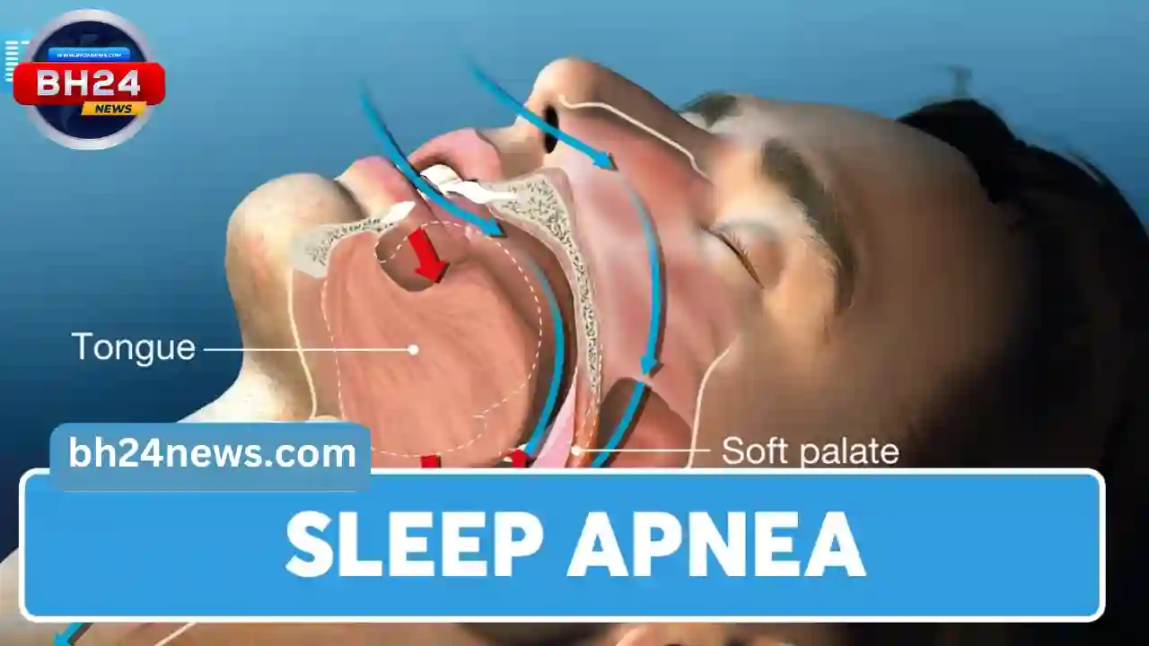 Sleep Apnea:
