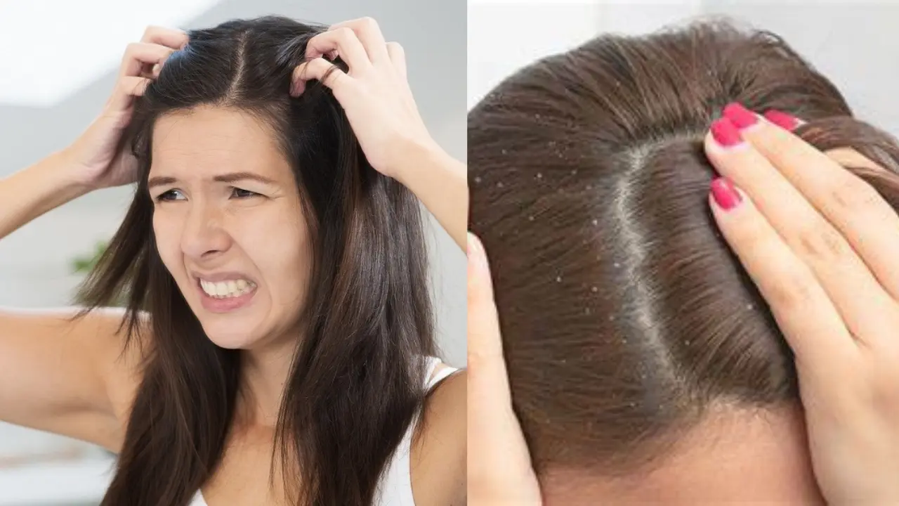 Homemade Shampoo for Dandruff: डैंड्रफ से परेशान है? तो इस होममेड शैंपू का इस्तेमाल करें, जो है गुणों से भरपूर…