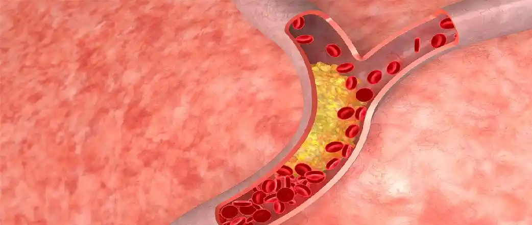 Cholesterol Problem