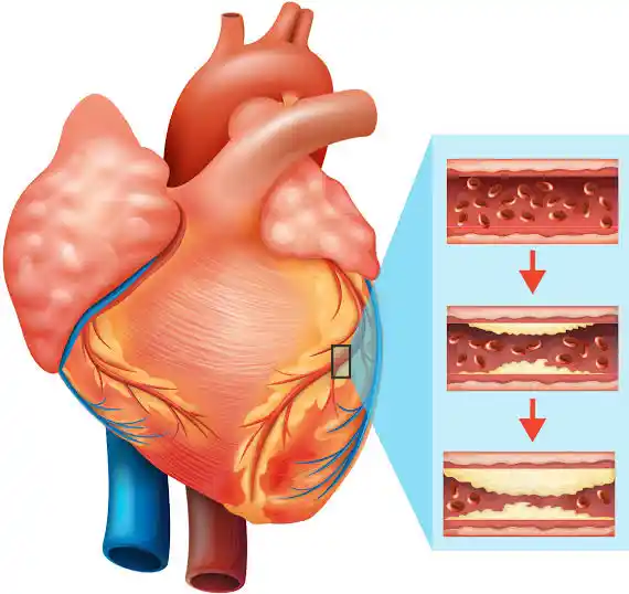 Heart Blockage Problem