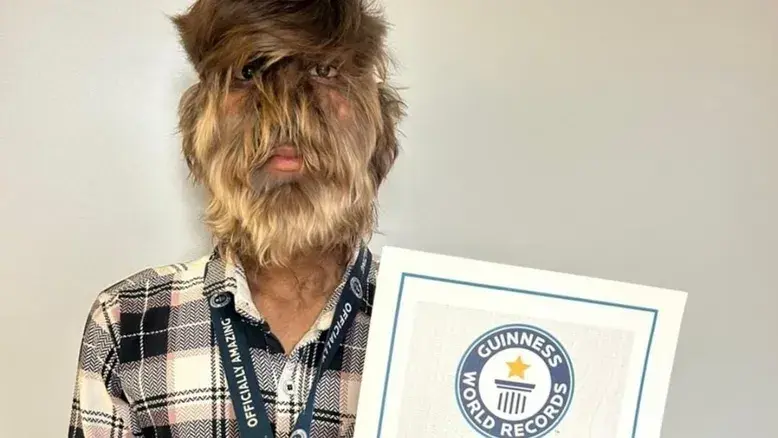 Werewolf Syndrome
